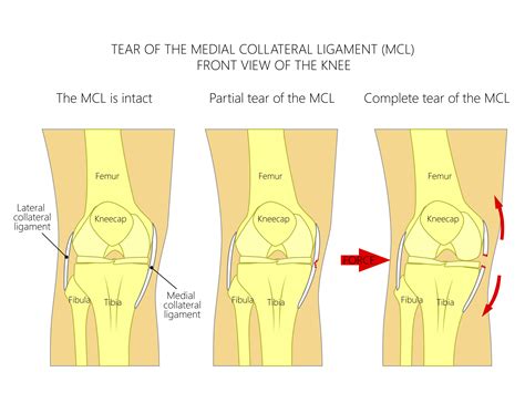 what worse mcl or meniscus